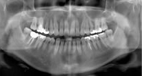 歯科用CT-撮影画像2